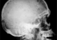 O tratamento com acupuntura em paciente com perda de memória resultante de traumatismo crânio-encefálico