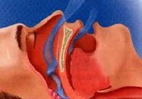 Acupuntura auricular na diminuição dos sintomas da Síndrome da Apneia Obstrutiva do Sono: