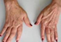 Acupuntura na artrite reumatóide