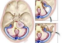 Tratamento com Acupuntura de Sequelas Decorrentes de Ressecção de Tumor benigno do acústico – SCHWANNOMA VESTIBULAR