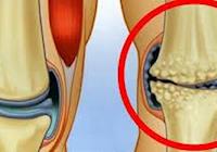 Tratamento de Artrose com Acupuntura e Auriculoterapia