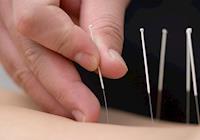 A acupuntura para melhora da saúde corporal e autoestima