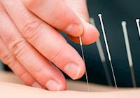 A acupuntura e seus benefícios para a saúde e a estética