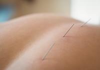 A eficácia da acupuntura para o tratamento da ansiedade