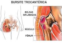 BURSITE TROCANTÉRICA DE QUADRIL: Busca de equilíbrio e retirada da dor através da acupuntura com a técnica Shu Antigos